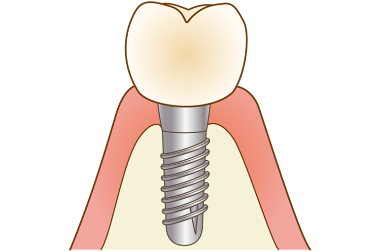 インプラント