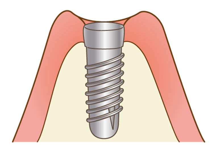 インプラント本体埋入（一次手術）